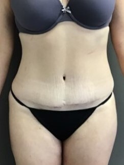 Anterior After