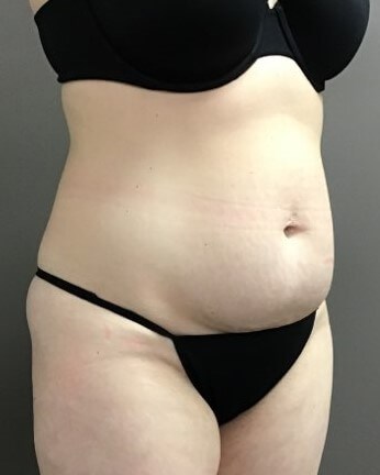 Oblique Before