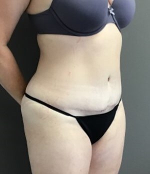 Oblique After