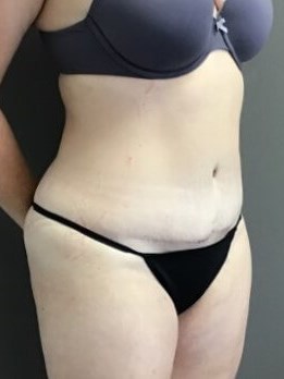 Oblique After