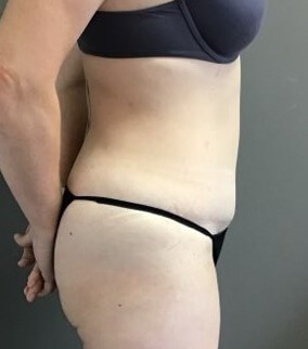 Side After