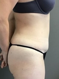 Side After