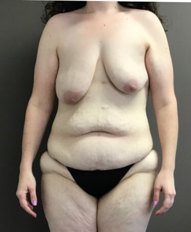 a Before