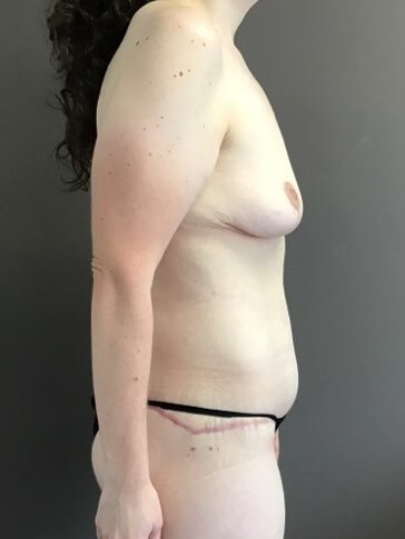 Side After