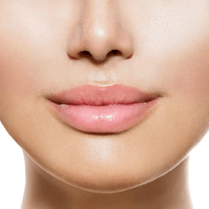 Lip Augmentation
